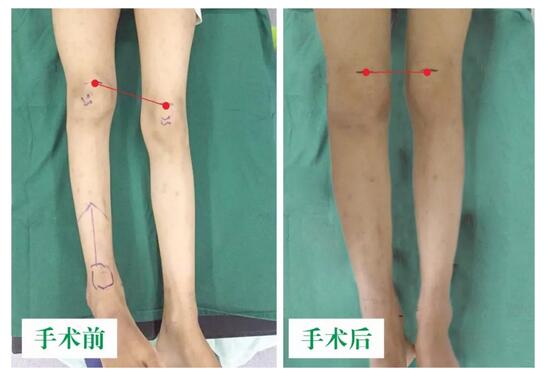 女孩墜梯右腿縮短5cm，幸得醫(yī)生及時(shí)診治恢復(fù)正常腿型