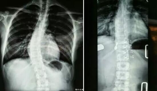 好好的脊柱怎么說彎就彎了？你竟然都沒發(fā)現(xiàn)……