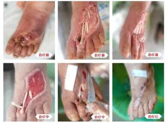 糖尿病并發(fā)癥有多可怕，及時治療糖尿病足避免截肢！