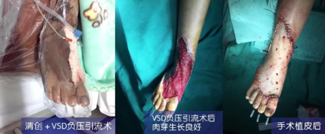 車禍猛如虎，救治如“華佗” ，手術(shù)＋康復(fù)，8歲小女孩車禍后日漸康復(fù)行走