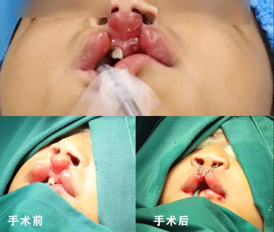 唇腭裂盡早治療消除孩子自卑心理，快樂成長！