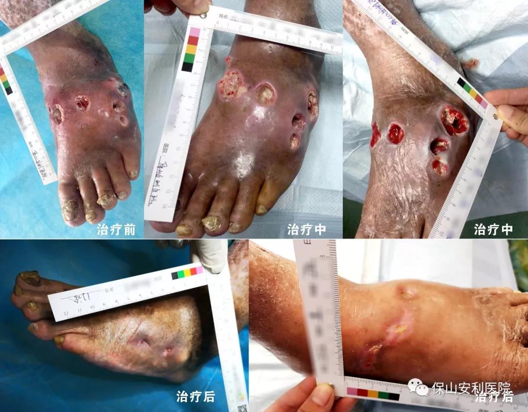 痛風腳面創(chuàng)口6個“洞”經創(chuàng)面負壓聯合自體富血小板凝膠治療痊愈