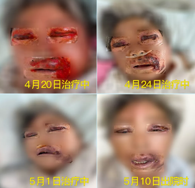 膿毒血癥（急性頜面部蜂窩組織炎）多學(xué)科聯(lián)合會(huì)診，幫助患者成功治愈！