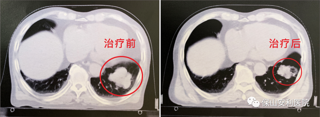 不做手術(shù)，早期肺癌也能根治！