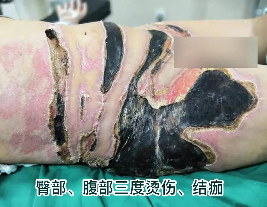 【保山安利醫(yī)院】80歲老人不慎燒傷，導(dǎo)致腹部、右側(cè)臀部大面積創(chuàng)傷，經(jīng)植皮治療創(chuàng)面逐漸愈合
