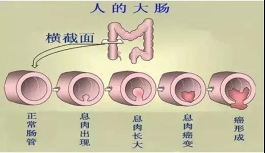 體檢發(fā)現(xiàn)腸息肉會(huì)癌變嗎？