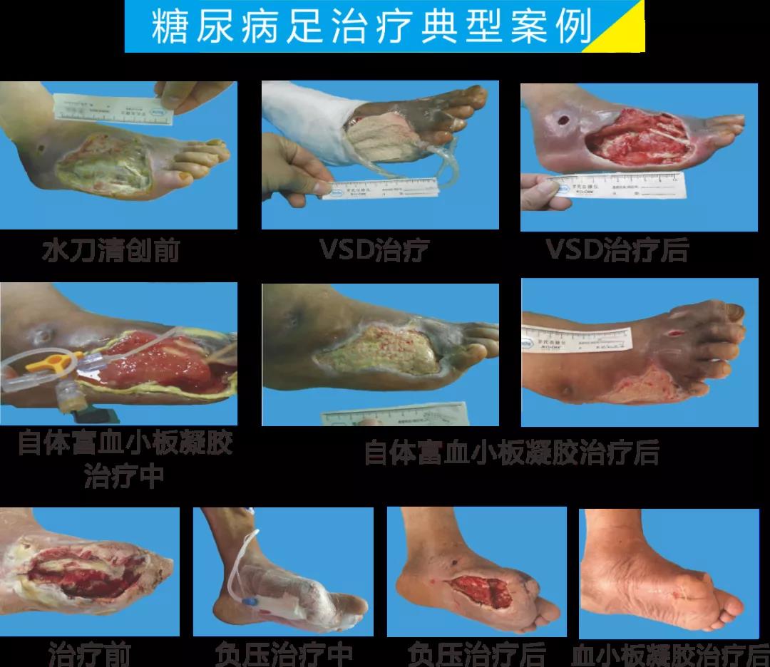 截肢、失明，甚至……，我們要做的是將糖尿病并發(fā)癥遏制在搖籃里！