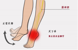【保山安利醫(yī)院—健康科普】什么是足下垂！你了解嗎？
