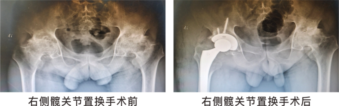 【保山安利醫(yī)院】長期飲酒導(dǎo)致雙側(cè)股骨頭壞死，髖關(guān)節(jié)置換后重獲運(yùn)動(dòng)功能！