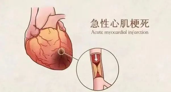 【保山安利醫(yī)院】11月20日“心梗救治日” 時間就是心肌，時間就是生命！
